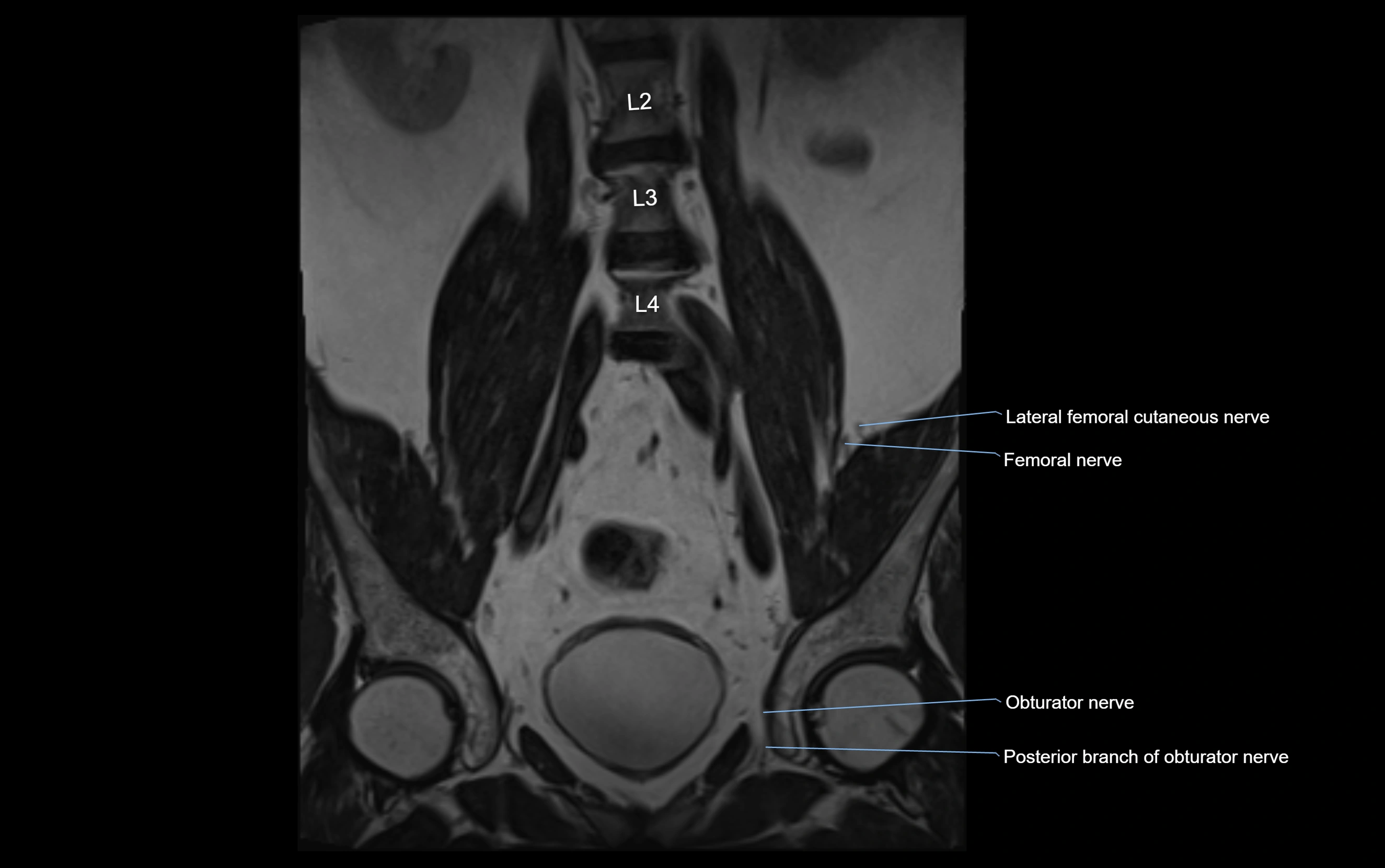 MR lumbosacral plexus cross sectional anatomy 3T  radiology  image-img-09001-00013.webp